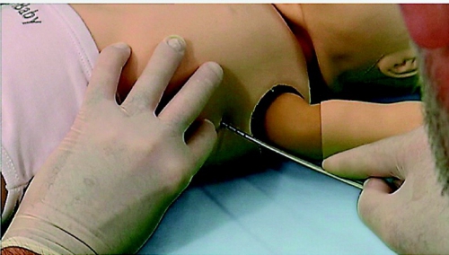 Screen Shot Chest Tube Insertion